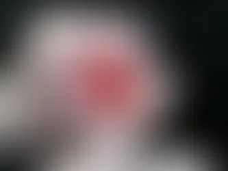 Laser de Diodo para Tratamento de Hemorroidas