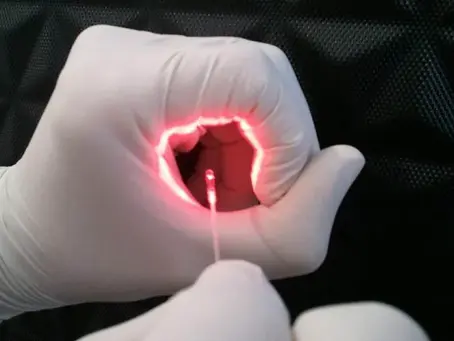 Laser de Diodo para Tratamento de Hemorroidas