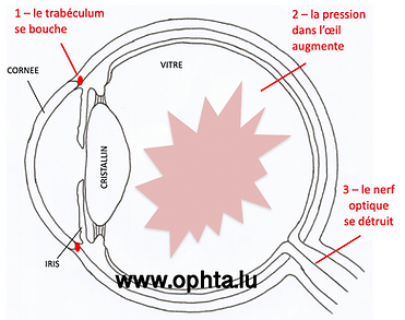 glaucome | chirurgie du glaucome | Luxembourg