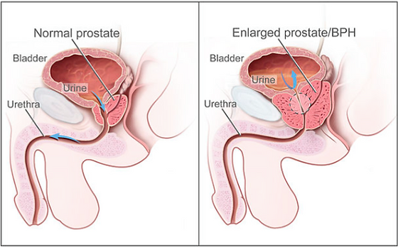 prostatic+hyperplasia+usmle
