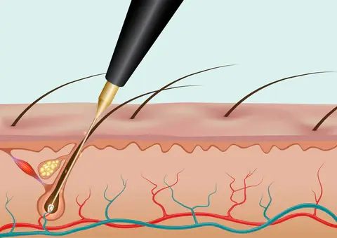 needle going into follicle