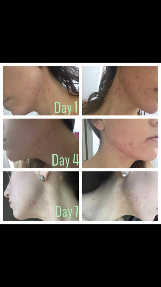 Thumbnail: Oily To Acne DayTime Moisturizer