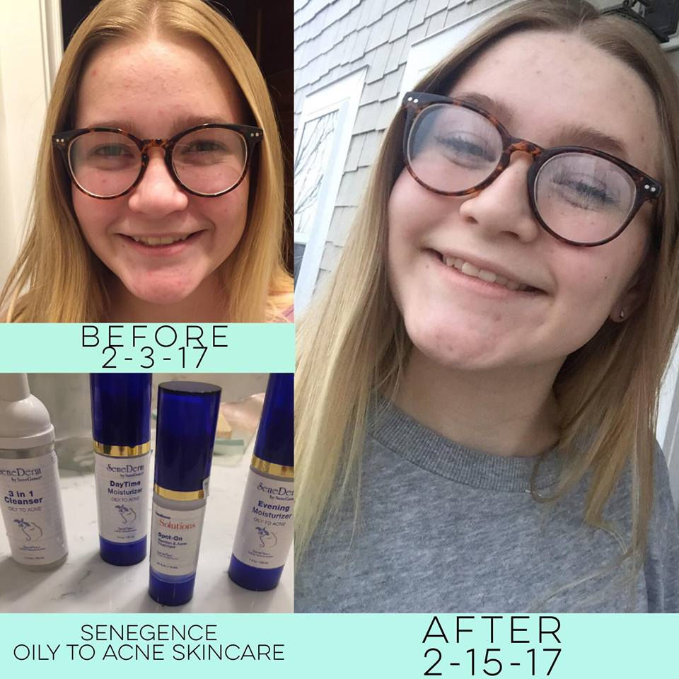 Thumbnail: Oily To Acne DayTime Moisturizer