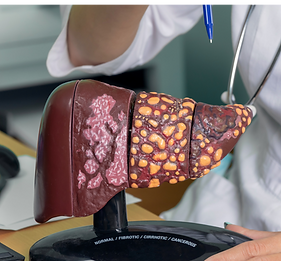 Close up of model of a human liver with the words normal, fibrotic, cirrhotic, cancerous.