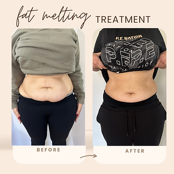 Before and after stomach fat freezing at Contoured x Kate – reduced abdominal fat and tighter midsection.