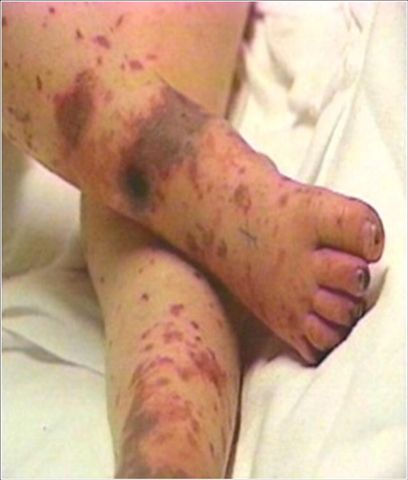 septicaemia baby with purple toes.jpg