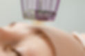Microneedle mesotherapy. Woman receiving micro needling rejuvenation treatment in a cosmet