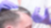 PRP Therapy - Hair Growth Treatment