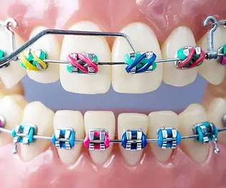 ORTHODONTIC BRACES