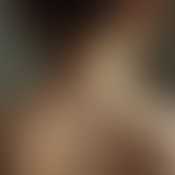 Cupping Therapy: Understanding the Marks