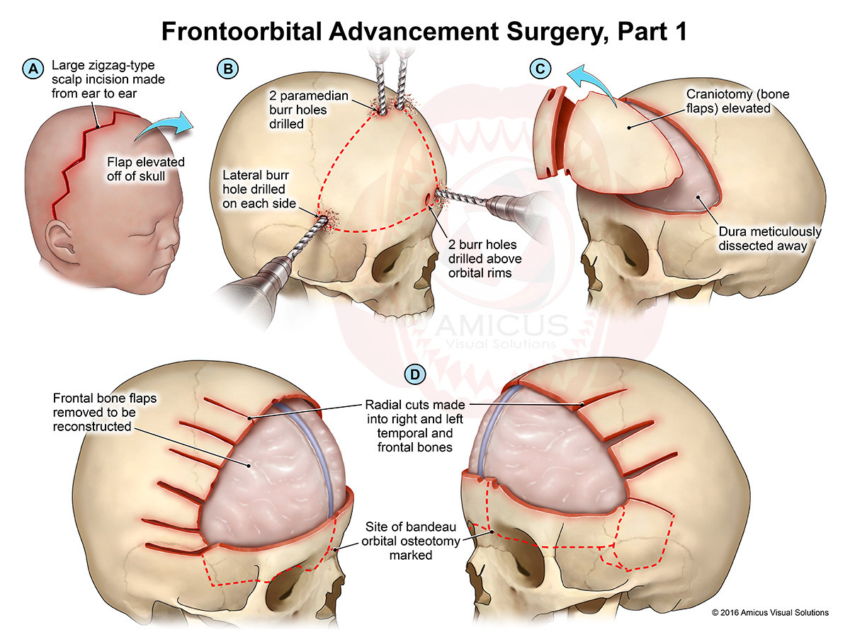 تسطح الرأس الأمامي عند الأطفال