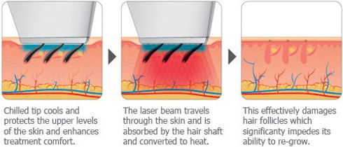 Laser Hair Removal Toronto