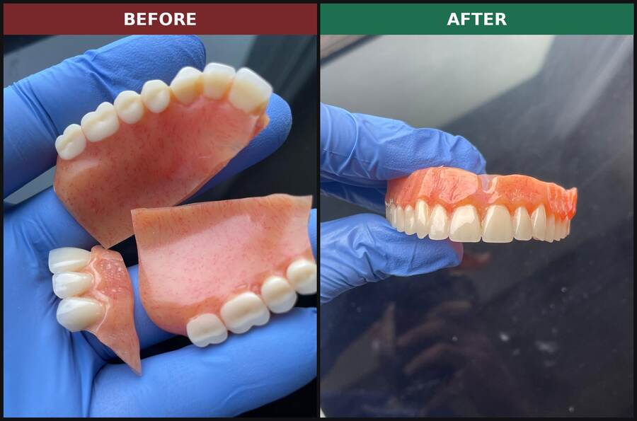 Before and after: upper denture broken in three pieces, rejoined at our Stoneham lab near Medford and Malden