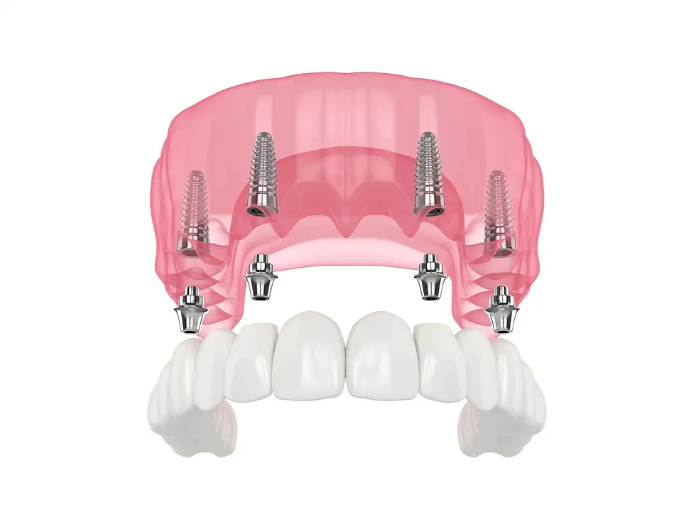 All On 4 Dental Implants