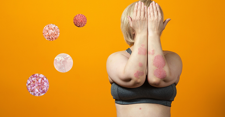 How does the Microbiome Affect Psoriasis Onset?