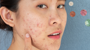 Acne, Microbiome, and Probiotics: The Gut–Skin Axis