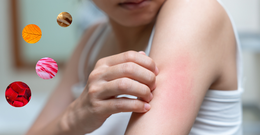 T Cell Cancer Rash Cutaneous T-Cell Lymphoma and the Skin Microbiome: A Hidden Link to ...