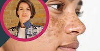 Sequential: Testing shows skin microbiome plays a role in hyperpigmentation
