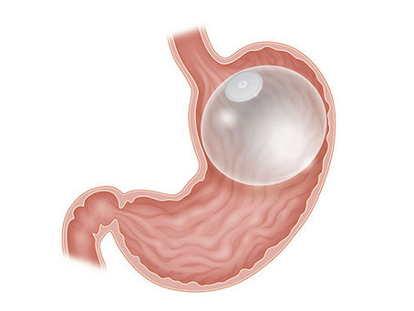 Are there dietary restrictions after a gastric balloon in Dubai?