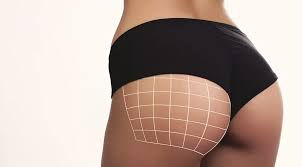 Can Brazilian Buttock Augmentation in Abu Dhabi Be Done If You Are Overweight?