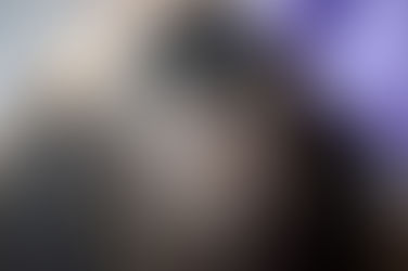 Will I need multiple sessions for stem cell hair transplantation?