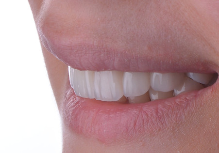 veneers istanbul