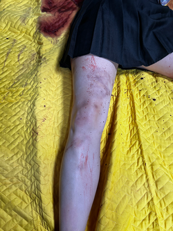 Dead body, blood and bruises on leg FX by Melissa K. Webb
