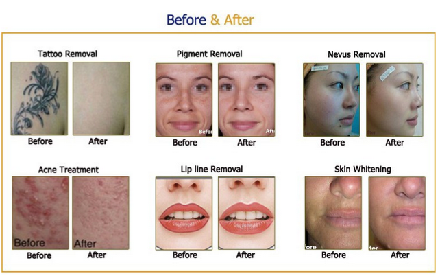 Thumbnail: Q-switched and ND YAG Laser Machine for Skin Rejuvenation and Tattoo Removal