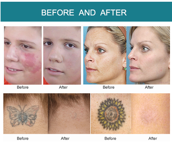 Thumbnail: Picosecond Technology Tattoo Removal and Skin Rejuvenation Laser Machine