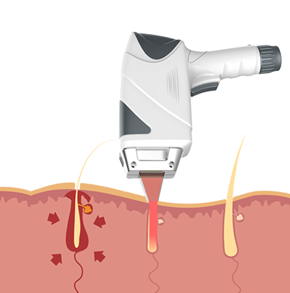 Thumbnail: Professional Diode Laser Hair Removal Machine