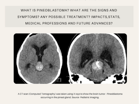 Pineoblastoma