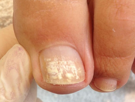 White spots under polish! What causes them?