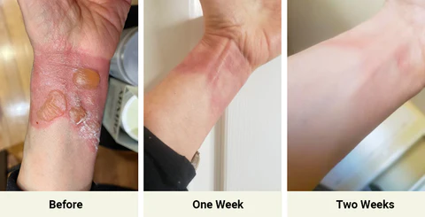 Fast-Burn-Healing