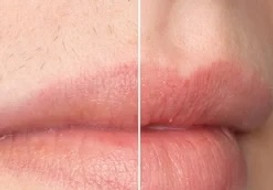 Before & After Laser Hair Removal on lips.