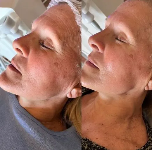 Cryo Facial near me
