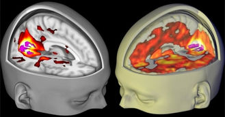 Brain Scans Reveal How LSD Affects Consciousness