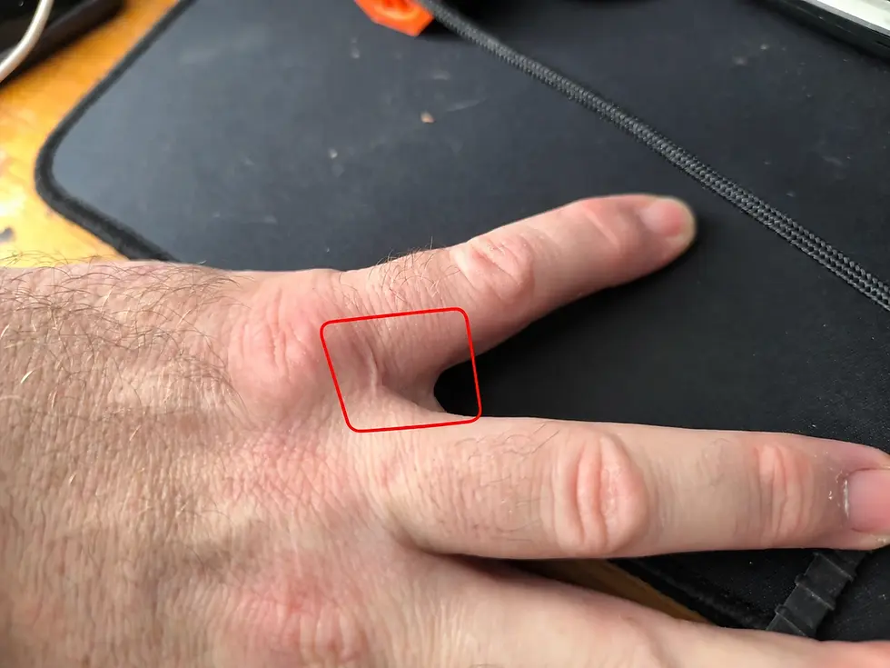 Small scar between my 2 left hand fingers from a woodturning accident, with the affected area highlighted.
