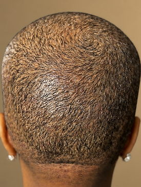 Baseline rear scalp view showing visible thinning and reduced hair density during a trichology assessment.