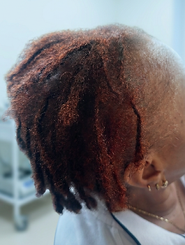 Baseline side view of a client's scalp showing visible thinning during a trichology assessment.
