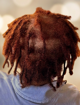 Progress view of the client's hair and scalp during an ongoing personalized trichology care plan.