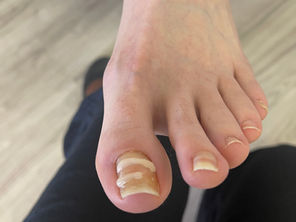 Is Onyfix Permanent?