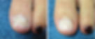 Before and After with Keryflex Nail Restoration