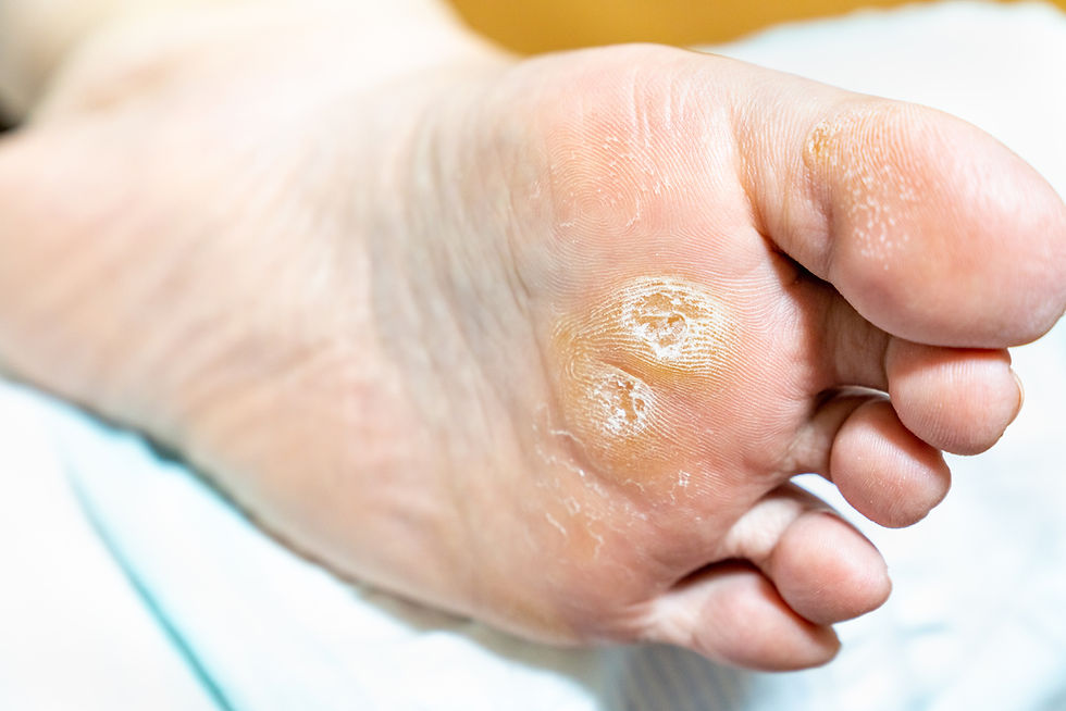 callus on diabetic foot