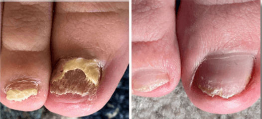 Before and after laser toenail fungus treatment at Direct Podiatry Arizona in Phoenix