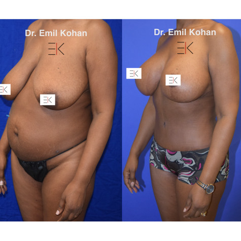 VRiley before after Mommy makeover.005.j