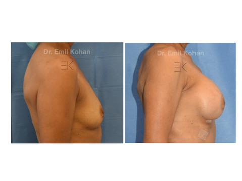 Breast Augmentation