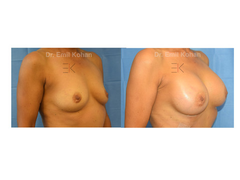 Breast Augmentation