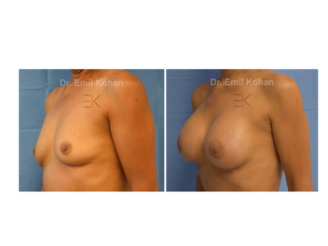 Breast Augmentation