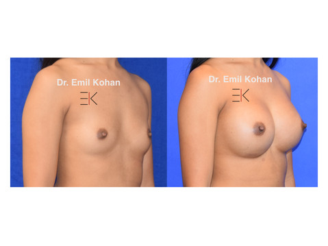Breast Augmentation