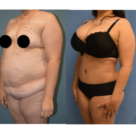 Liposuction and Tummy Tuck